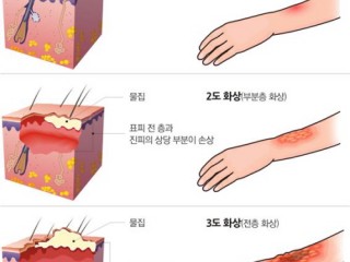 화상사고시 응급처치
