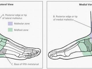 발목이 삐었어요
