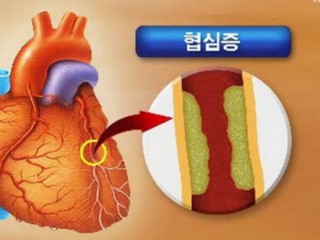 협심증 응급처치