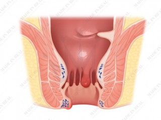 치질 예방수칙 6가지