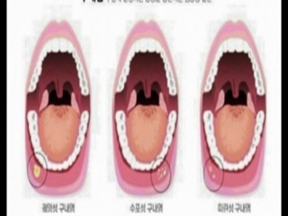 재발성 아프타성 구내염