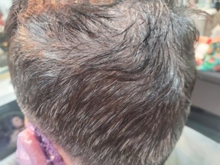 흰머리 & 탈모의 원인 진단