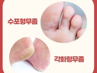 천하무적 '무좀군단' 한여름 대공습 예고