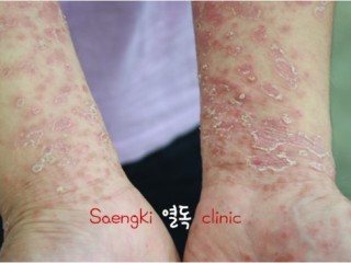 열독(熱毒) - 오리고기가 좋아