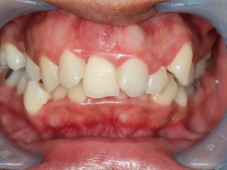 입안 염증, 풍치