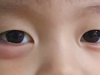 '눈 다래끼' - 검지 두번째마디 따주면 특효