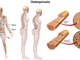 남자도 골다공증 걸린다