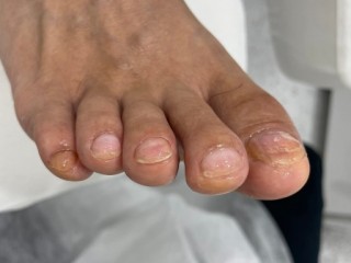 문제성 발 관리법