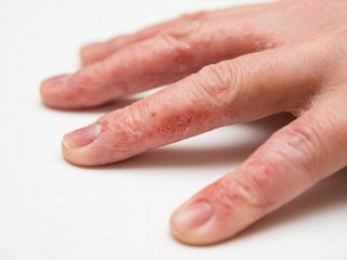 주부습진은 주부만 걸린다?