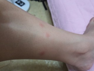 벌레 물린데 침 바르면 “역효과”