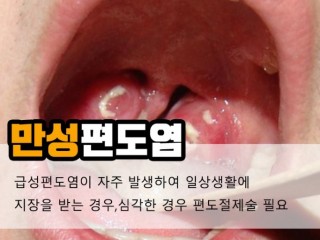 편도선염, 입냄새 나고 아동발육에도 장애
