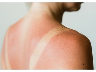 햇빛에 탄 피부에는 얼음찜질