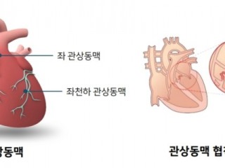 심장질환.....가슴통증 30분 지속, 돌연사 발생 위험