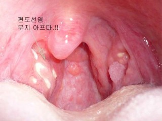 편도선 '잘라! 말아?'