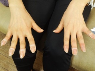 류머티스성 관절염