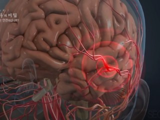 뇌졸증예방 "압담환"