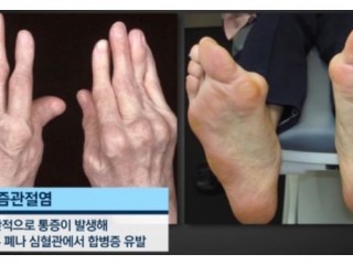 류머티즘성 관절염