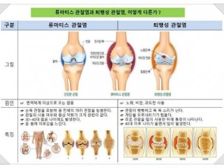 관절염엔 "녹홍슬환"