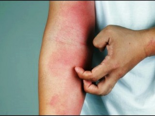 알레르기의 사상체질별 치료