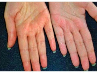 다한증…땀 안날땐 의사 찾아야