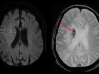 뇌경색, 성격이 급하면 발병위험