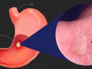 소화성궤양, `한번 궤양은 영원한 궤양'?