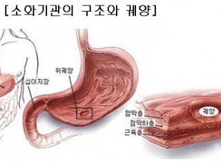 건강수첩-소화성 궤양
