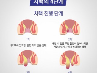 치질치료는 이렇게...야채 등 섬유질 듬뿍 먹으면 좋아