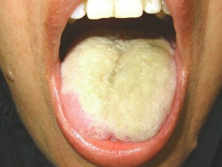 누런 설태 - 위염의심