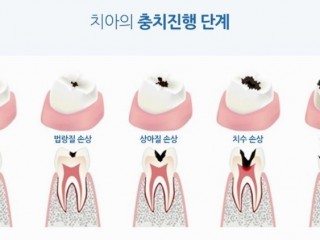 충치는 어떻게 생길까